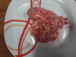 Diagnosing Intestinal Obstruction with a Stethoscope