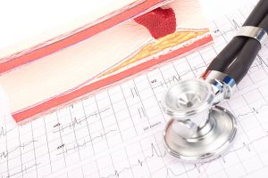 The Role of Stethoscopes in Advanced Heart Failure Management